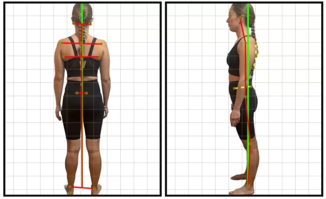 La valoración y el diagnóstico inicial es clave para los buenos resultados en las terapias de reeduación postural